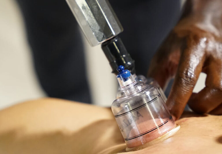 Dry Cupping Massage